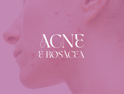 tratamentos-clinica-mulieri-ACNE E ROSÁCEA